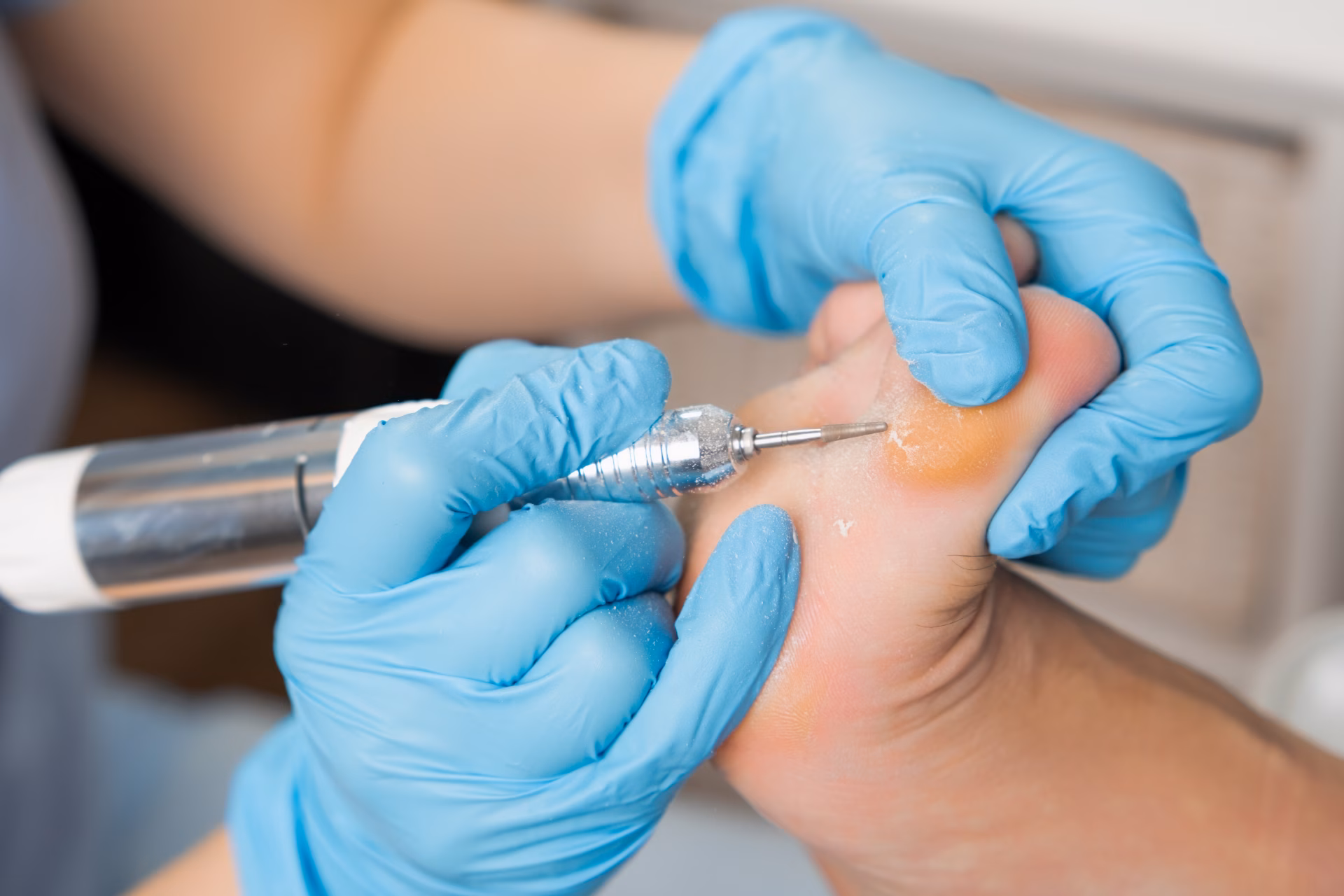 podologist carries out callus removal from a woman 2026 01 08 06 53 31 utc converted